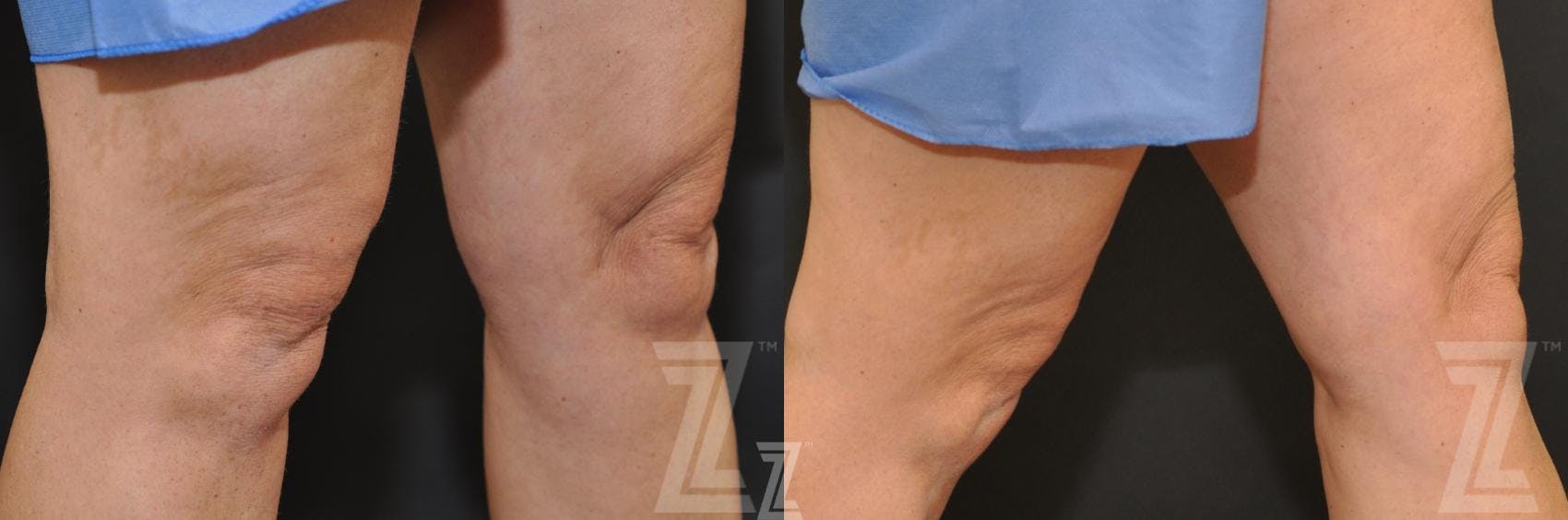 CoolSculpting® Before & After Gallery - Patient 132905392 - Image 2