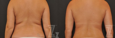 CoolSculpting® Before & After Gallery - Patient 132905393 - Image 1