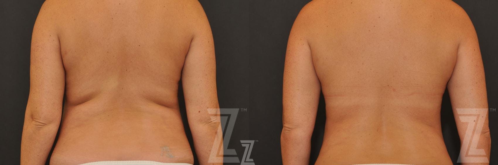 CoolSculpting® Before & After Gallery - Patient 132905393 - Image 1