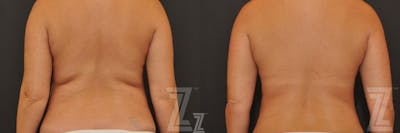 Austin CoolSculpting® Before & After Gallery - Patient 132905393 - Image 1 - The Piazza Center
