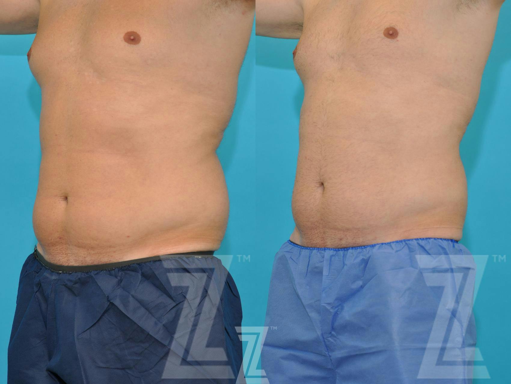 CoolSculpting® Before & After Gallery - Patient 132905395 - Image 1