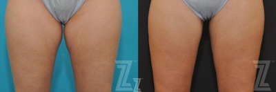 CoolSculpting® Before & After Gallery - Patient 132905396 - Image 1