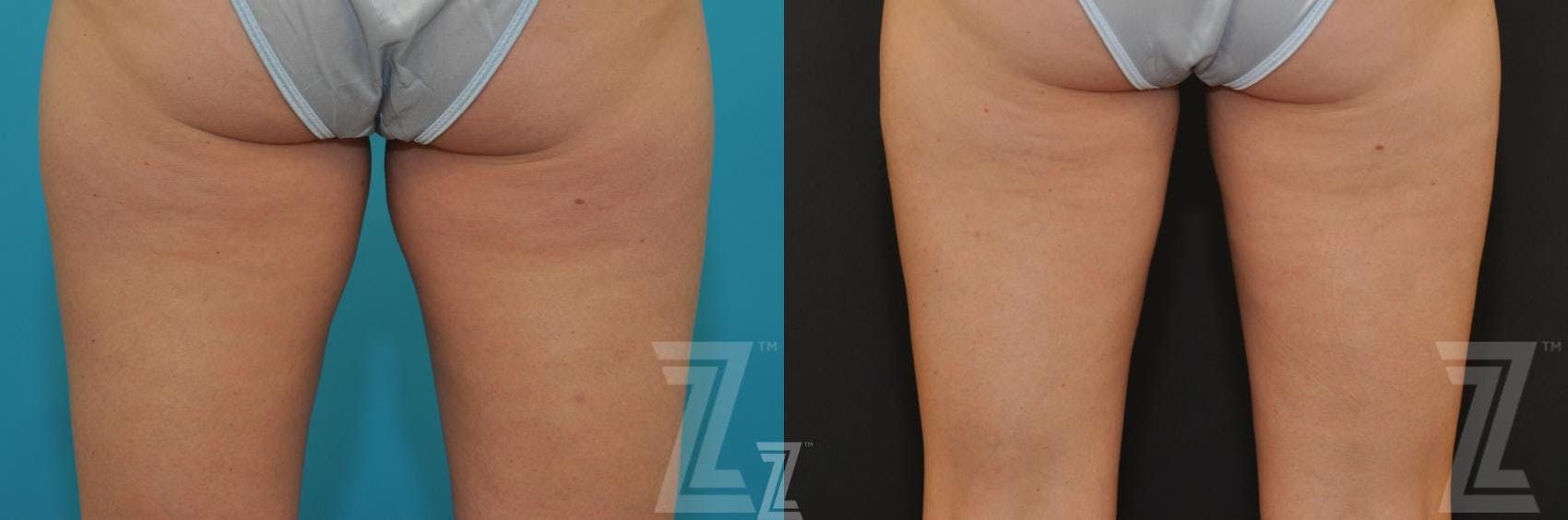 CoolSculpting® Before & After Gallery - Patient 132905396 - Image 2