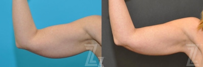 CoolSculpting® Before & After Gallery - Patient 132905397 - Image 1