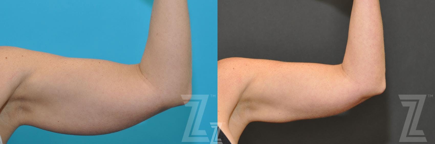 CoolSculpting® Before & After Gallery - Patient 132905397 - Image 2