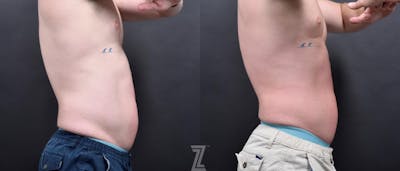 Austin Non-Surgical Male Body Contouring Before & After Gallery - Patient 258358 - Image 1 - The Piazza Center