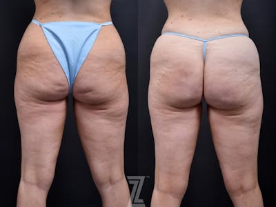 Austin Avéli Before & After Gallery - Patient 132905400 - Image 1 - The Piazza Center