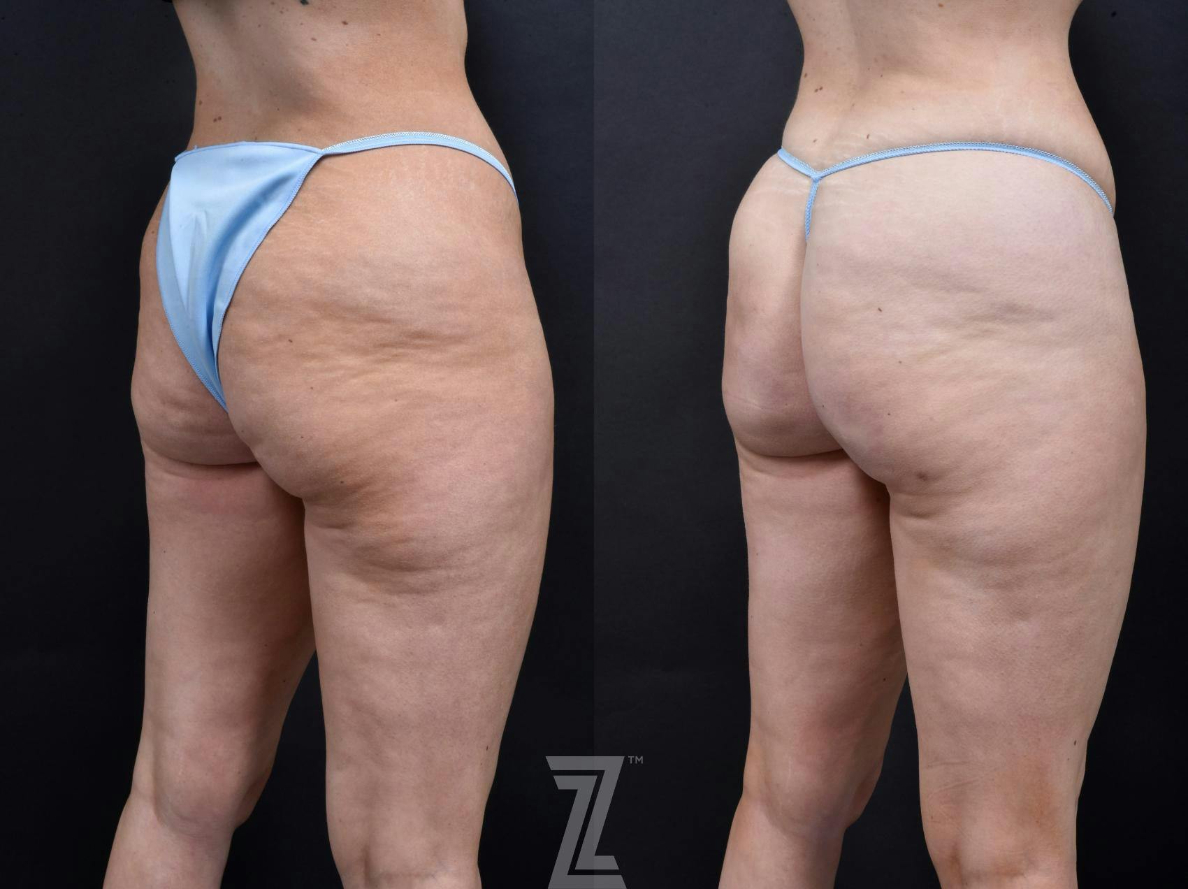 Avéli Before & After Gallery - Patient 132905400 - Image 3