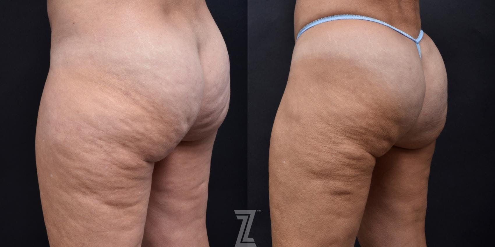 Avéli Before & After Gallery - Patient 132905402 - Image 2