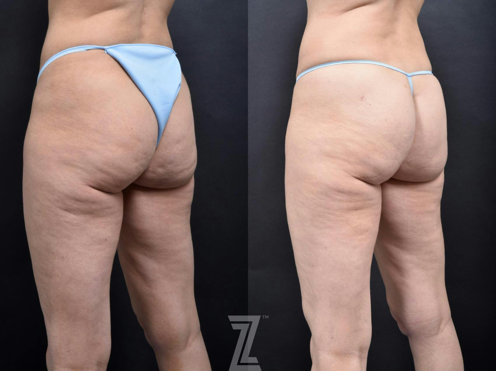 Avéli Before & After Gallery - Patient 132905407 - Image 2
