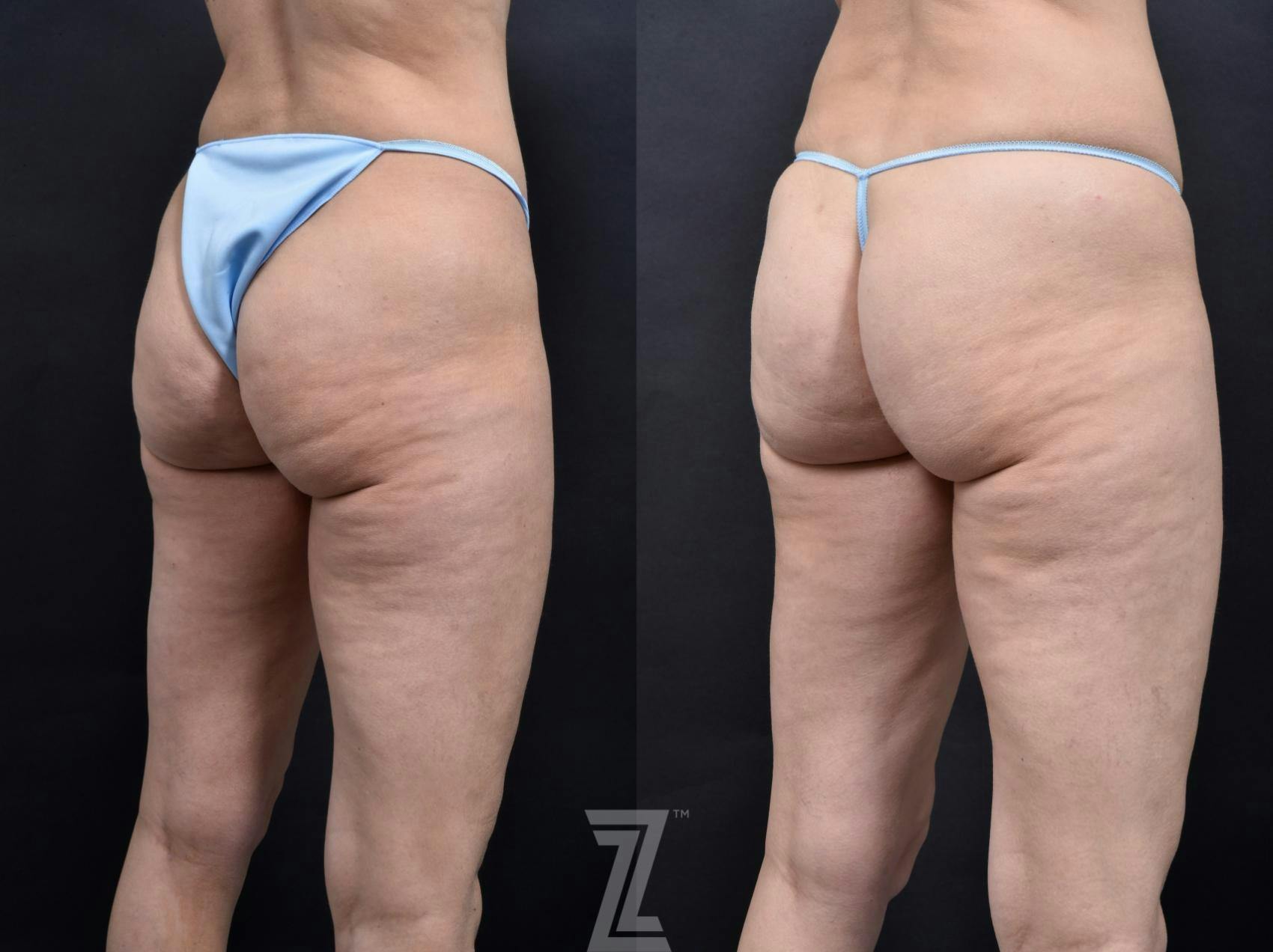 Avéli Before & After Gallery - Patient 132905407 - Image 3
