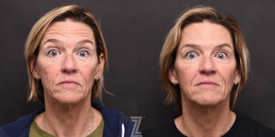 Austin Wrinkle Relaxers Before & After Gallery - Patient 132905408 - Image 1 - The Piazza Center