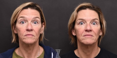Wrinkle Relaxers Before & After Gallery - Patient 132905408 - Image 1