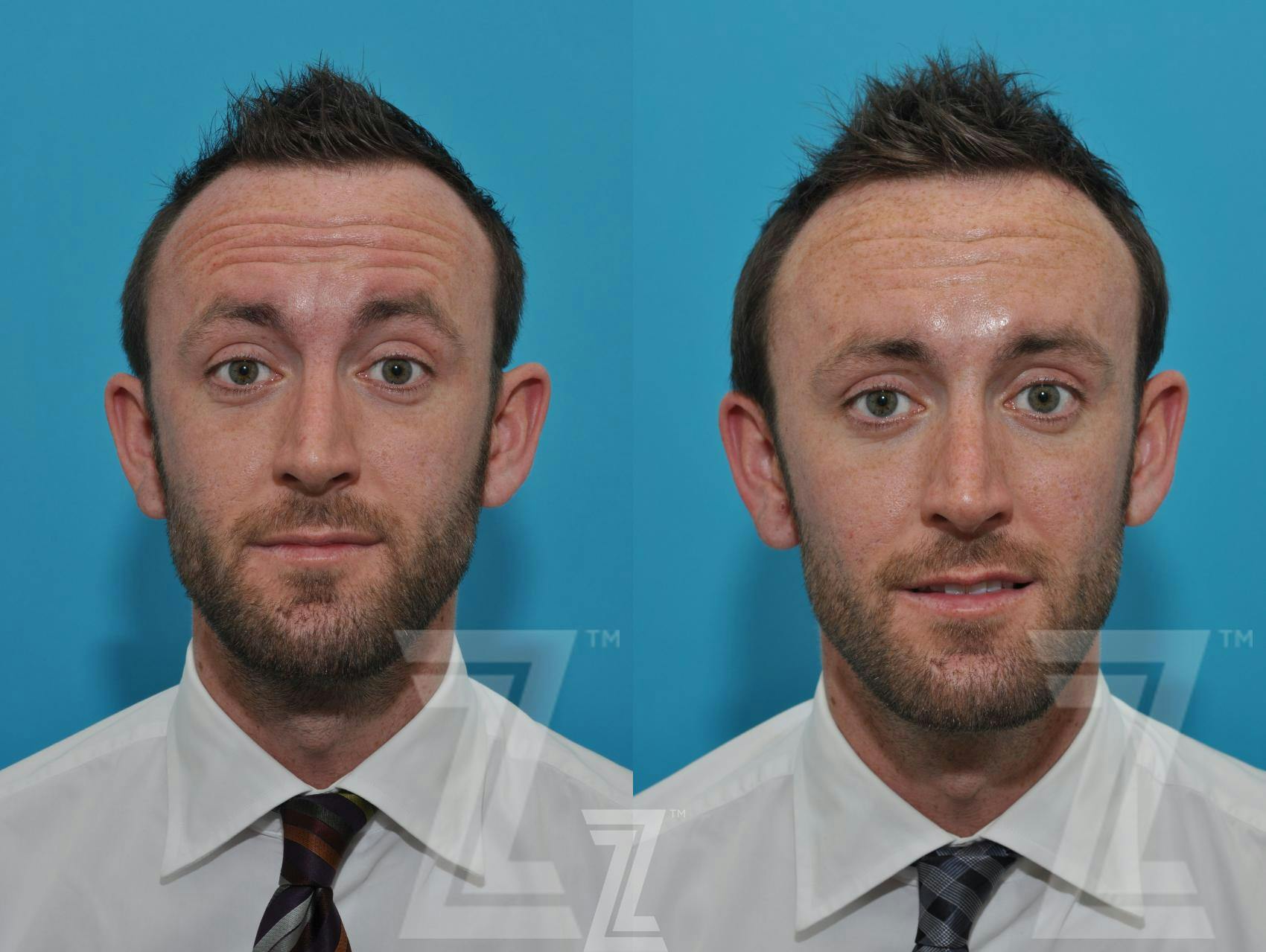 Wrinkle Relaxers Before & After Gallery - Patient 132905409 - Image 3