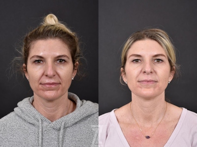 Wrinkle Relaxers Before & After Gallery - Patient 132906304 - Image 1