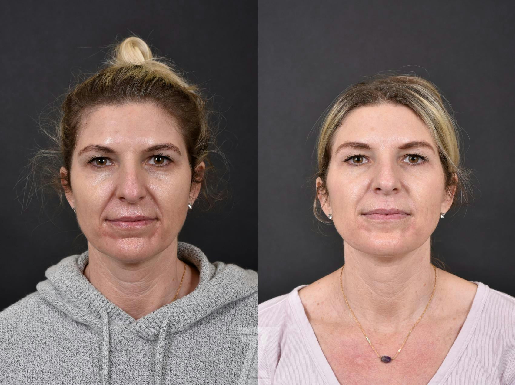 Wrinkle Relaxers Before & After Gallery - Patient 132906304 - Image 1