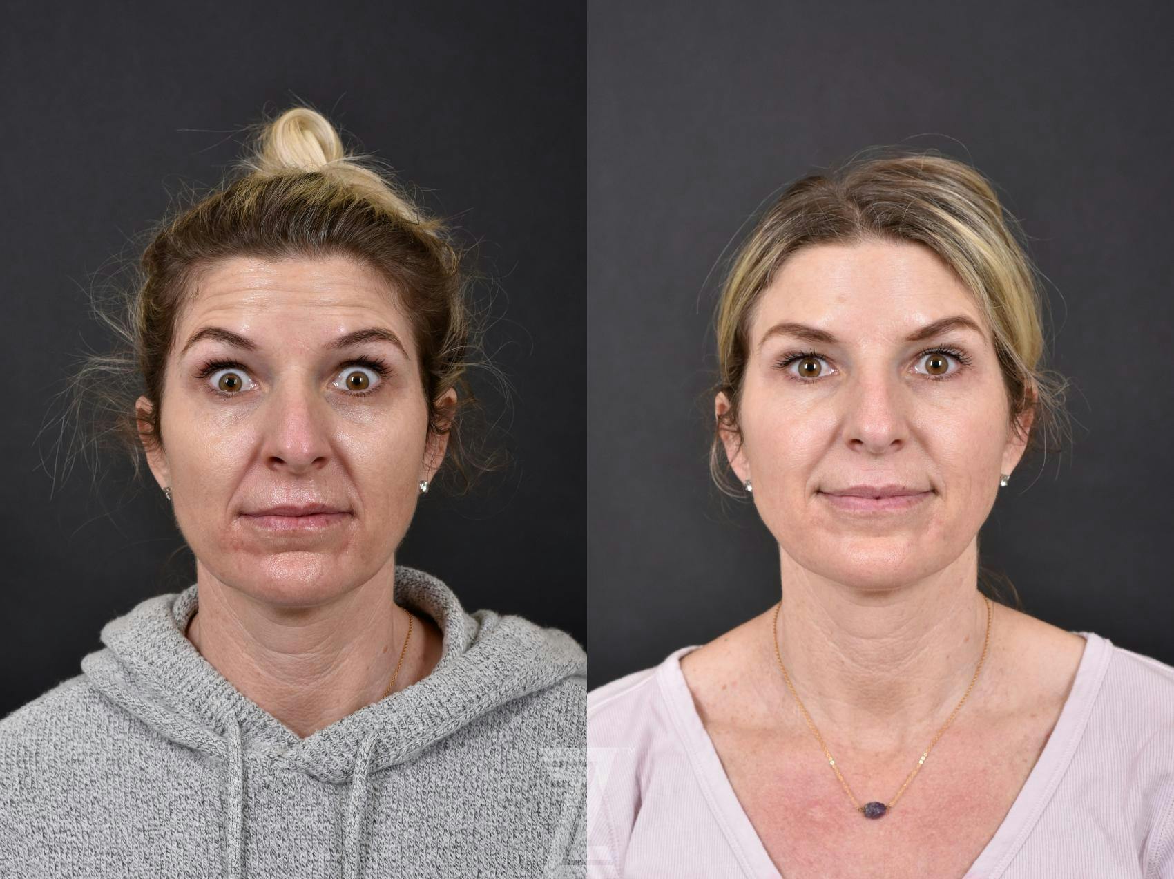 Wrinkle Relaxers Before & After Gallery - Patient 132906304 - Image 2