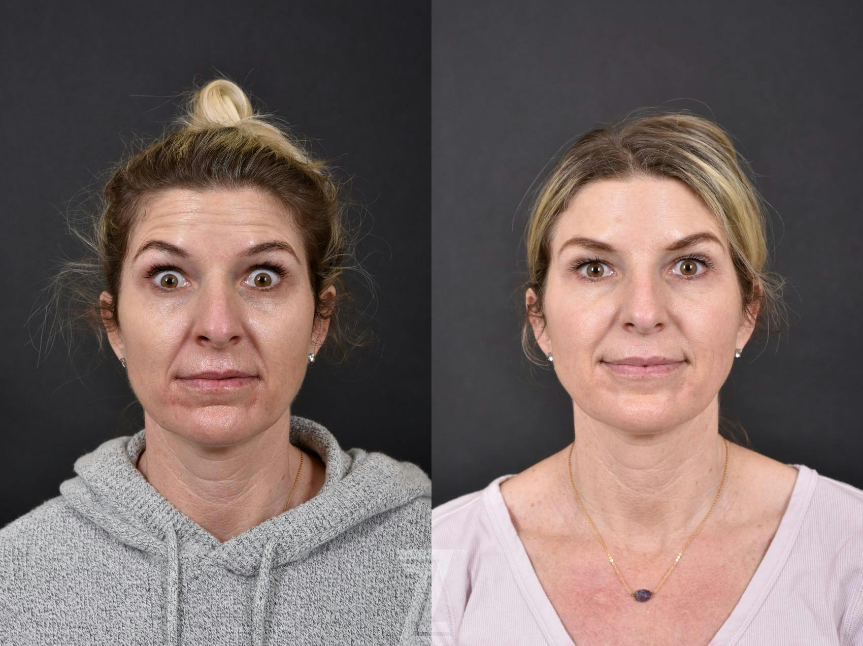 Wrinkle Relaxers Before & After Gallery - Patient 132906304 - Image 2