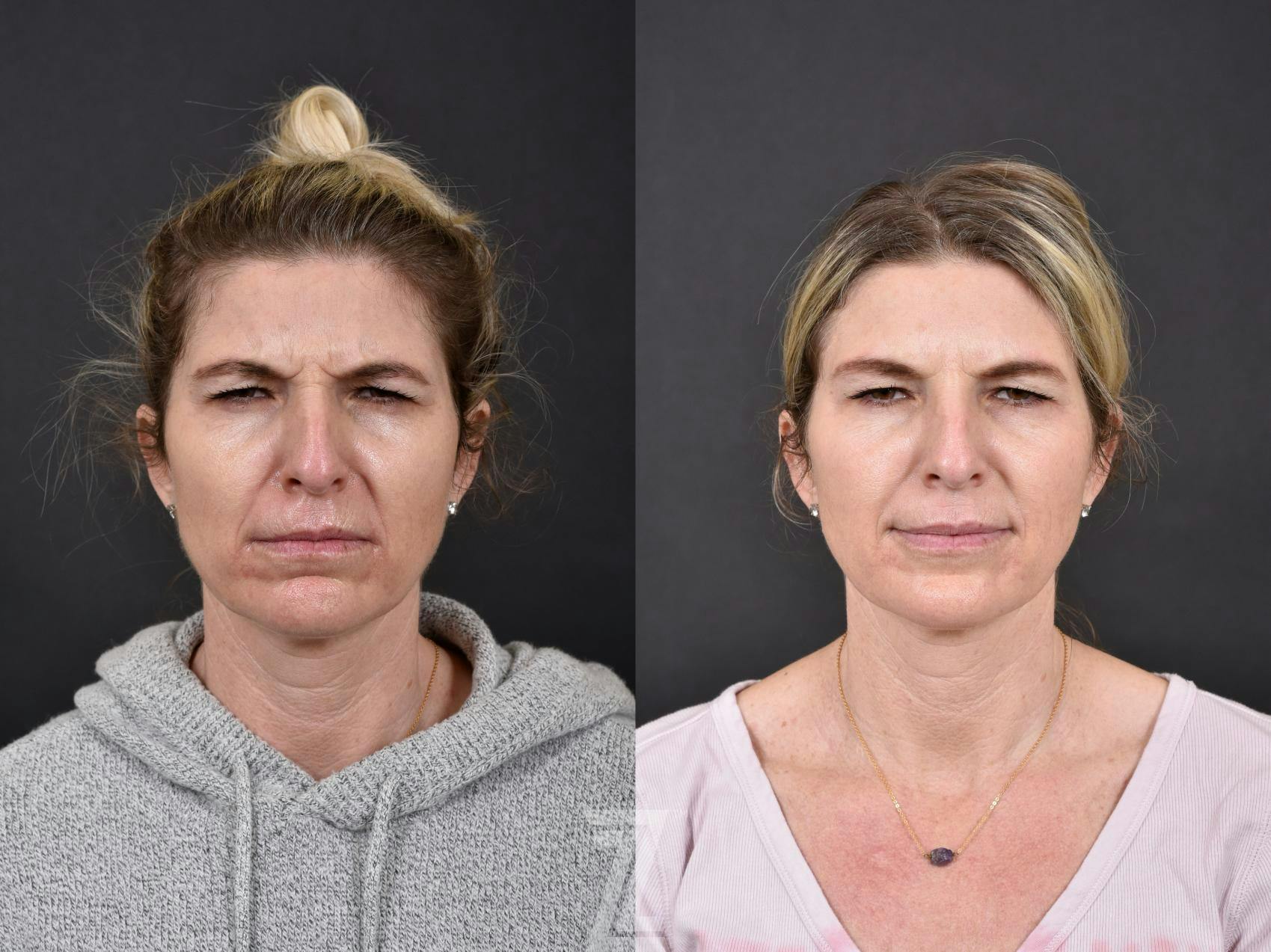Wrinkle Relaxers Before & After Gallery - Patient 132906304 - Image 3