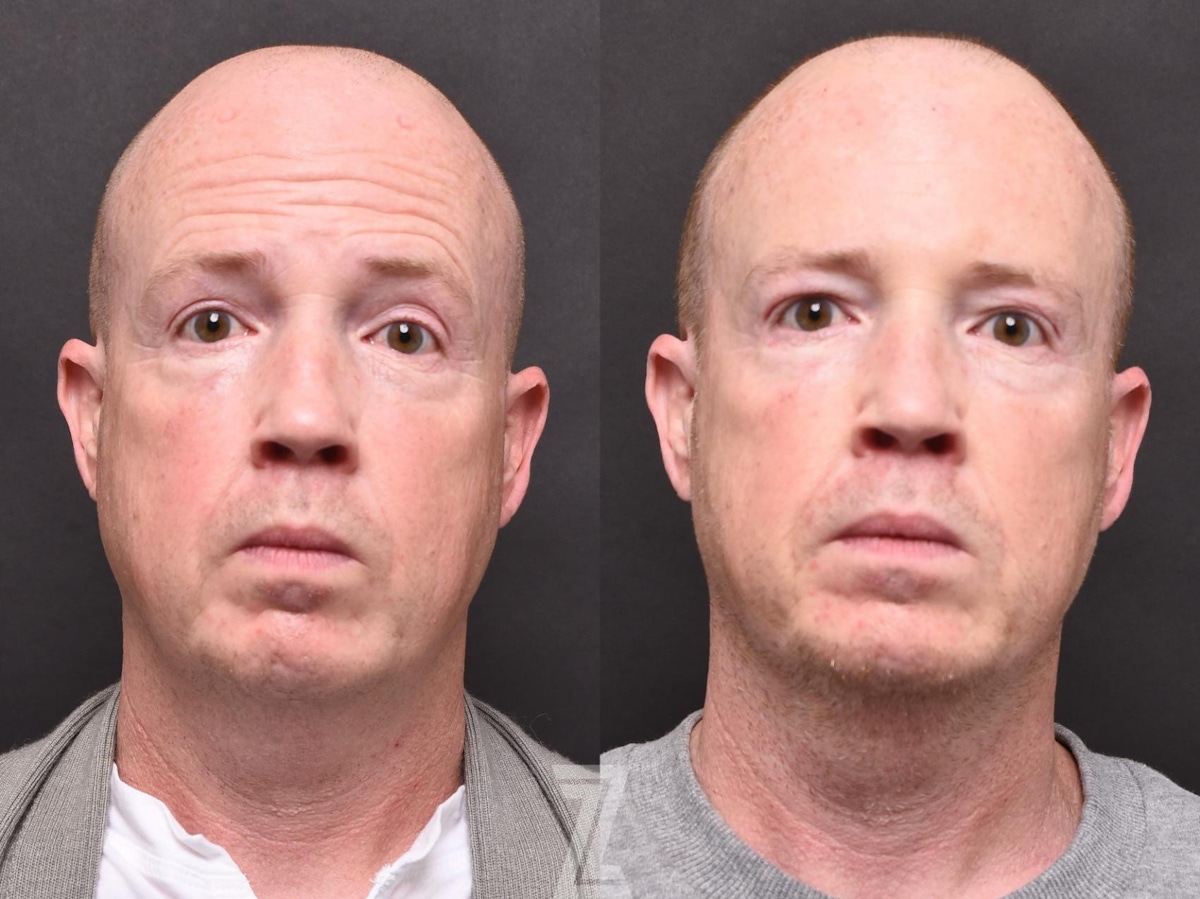 Austin Male Injectables Before & After Gallery - Patient 339871 - Image 1 - The Piazza Center