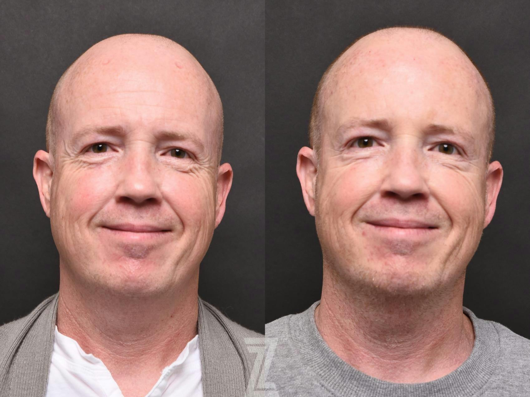 Wrinkle Relaxers Before & After Gallery - Patient 132906313 - Image 3
