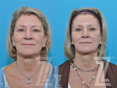 Wrinkle Relaxers Before & After Gallery - Patient 132906316 - Image 1