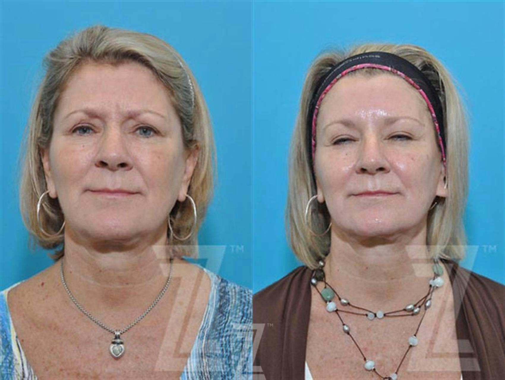 Wrinkle Relaxers Before & After Gallery - Patient 132906316 - Image 2