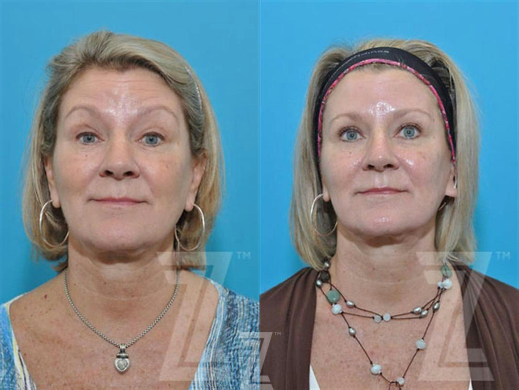 Wrinkle Relaxers Before & After Gallery - Patient 132906316 - Image 3