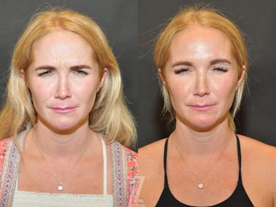 Wrinkle Relaxers Before & After Gallery - Patient 132906317 - Image 1