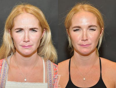 Austin Wrinkle Relaxers Before & After Gallery - Patient 132906317 - Image 1 - The Piazza Center