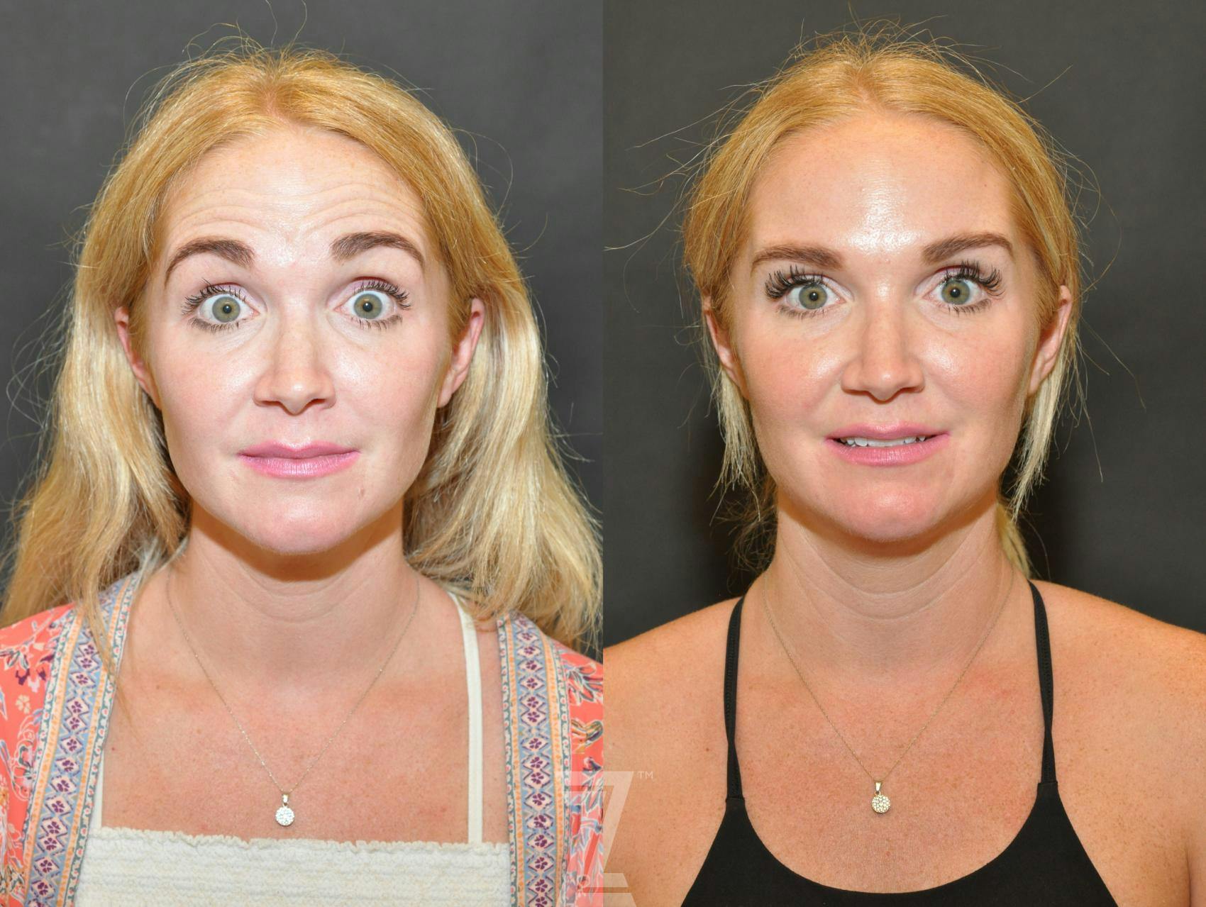 Wrinkle Relaxers Before & After Gallery - Patient 132906317 - Image 2