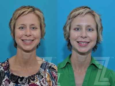 Wrinkle Relaxers Before & After Gallery - Patient 132906319 - Image 1