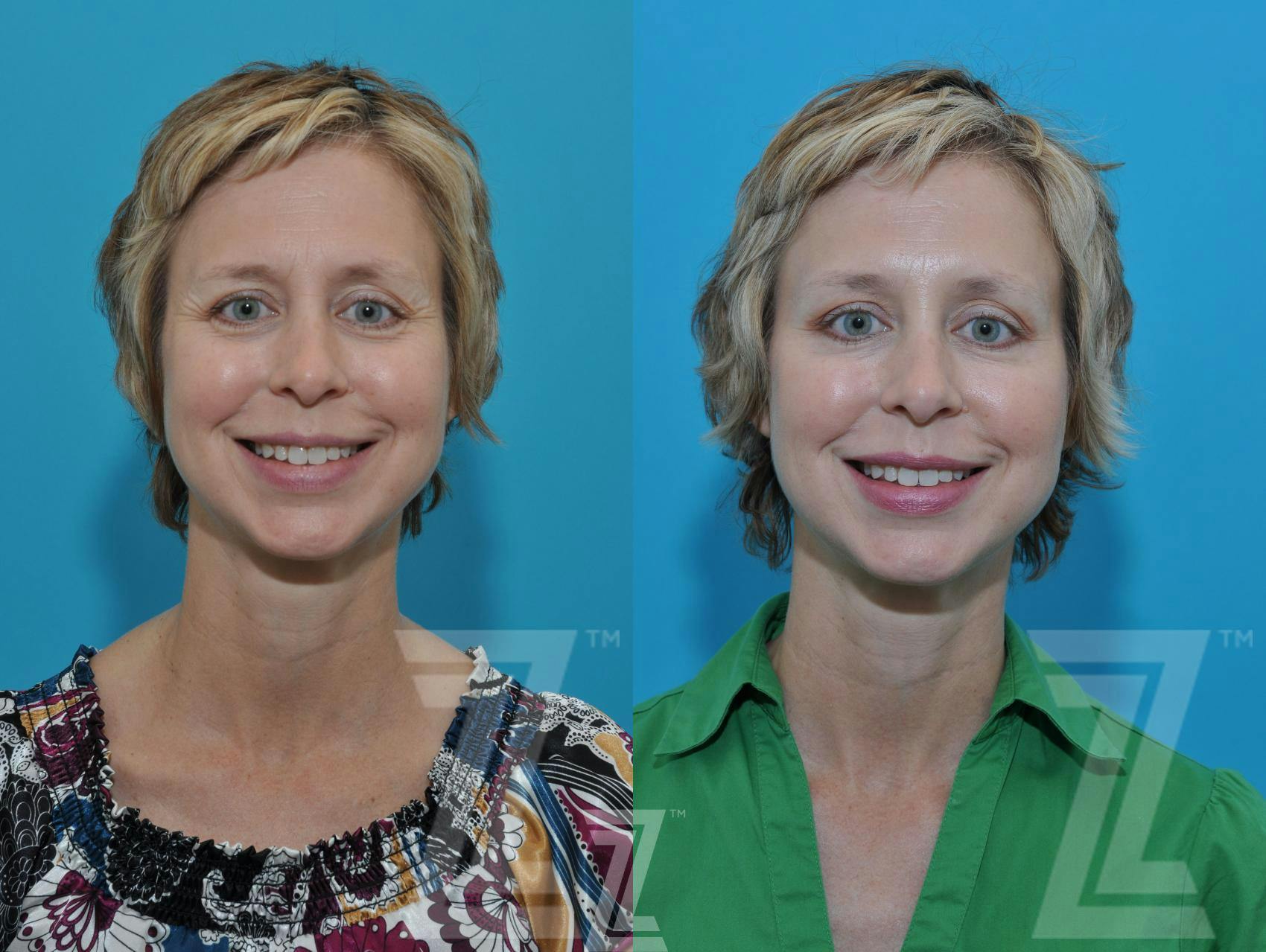 Wrinkle Relaxers Before & After Gallery - Patient 132906319 - Image 1