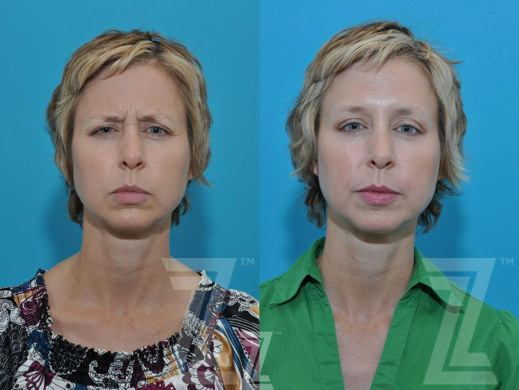 Wrinkle Relaxers Before & After Gallery - Patient 132906319 - Image 2