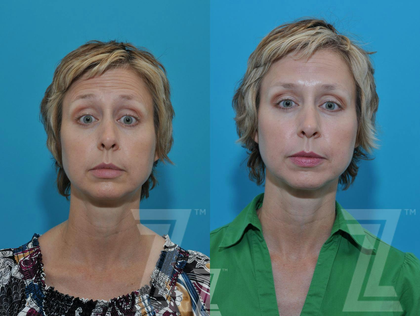 Wrinkle Relaxers Before & After Gallery - Patient 132906319 - Image 3