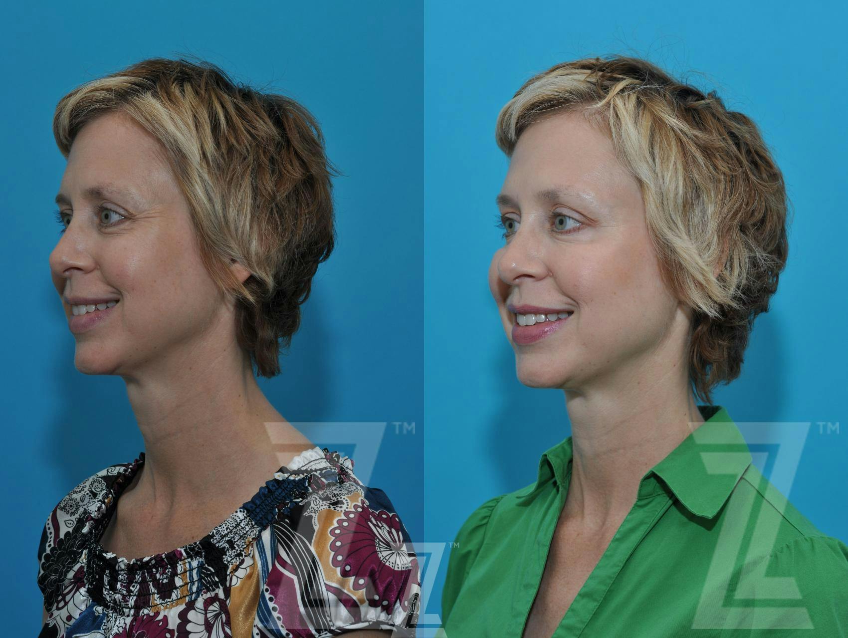 Wrinkle Relaxers Before & After Gallery - Patient 132906319 - Image 4