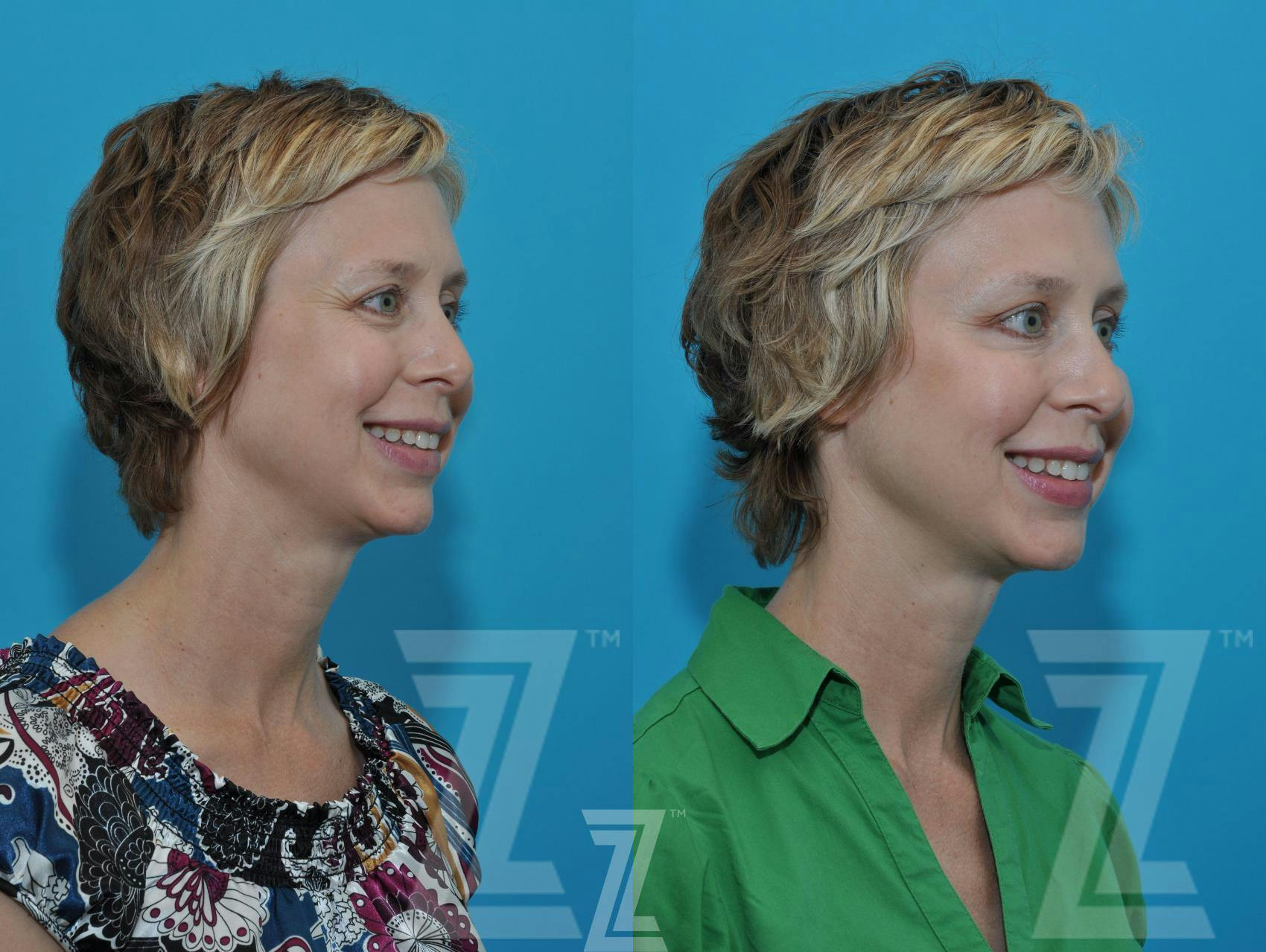Wrinkle Relaxers Before & After Gallery - Patient 132906319 - Image 5