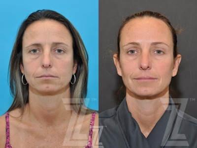 Wrinkle Relaxers Before & After Gallery - Patient 132906321 - Image 1
