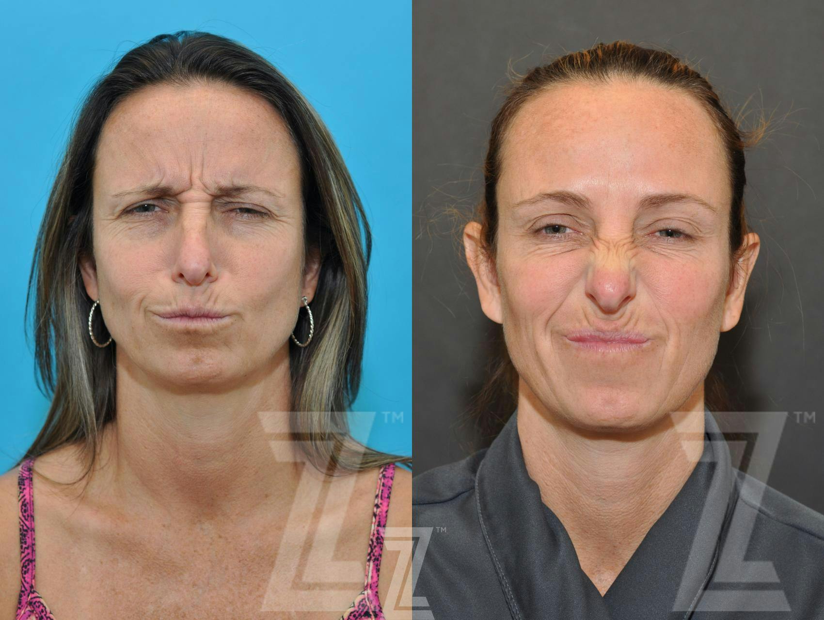 Wrinkle Relaxers Before & After Gallery - Patient 132906321 - Image 3