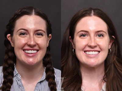 Wrinkle Relaxers Before & After Gallery - Patient 132906322 - Image 1