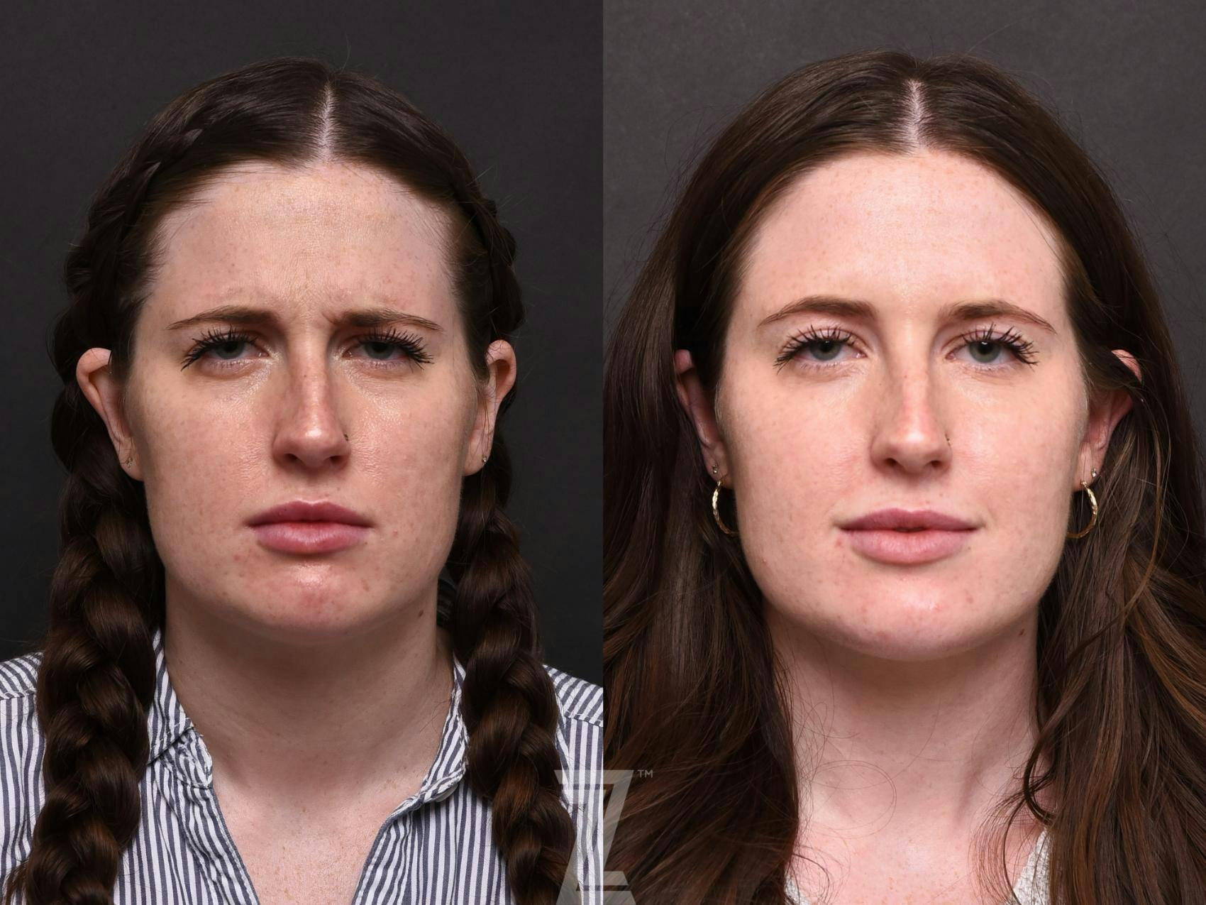 Wrinkle Relaxers Before & After Gallery - Patient 132906322 - Image 2