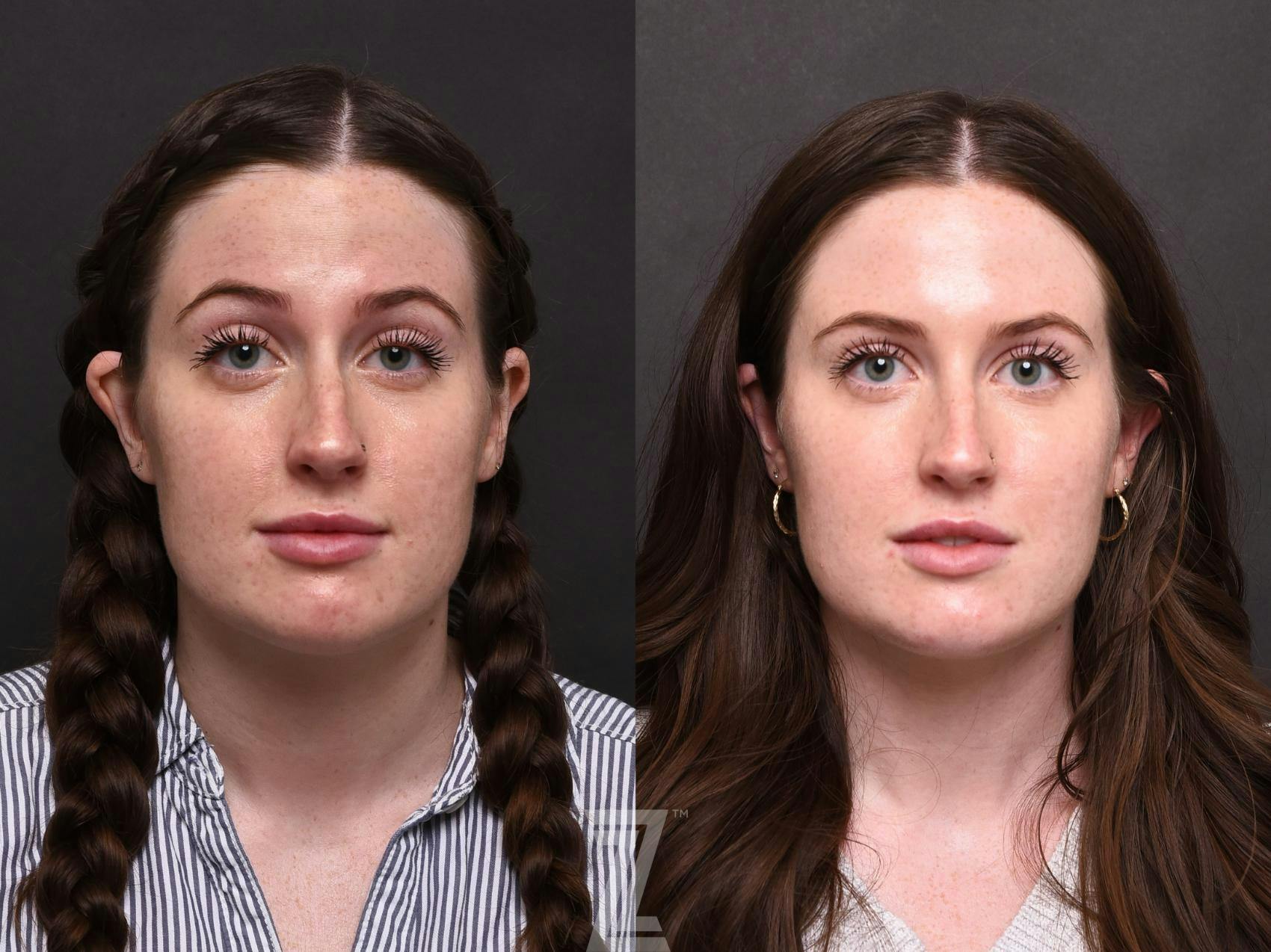Wrinkle Relaxers Before & After Gallery - Patient 132906322 - Image 3