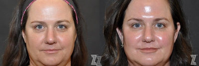 Injectable Fillers Before & After Gallery - Patient 132906324 - Image 1