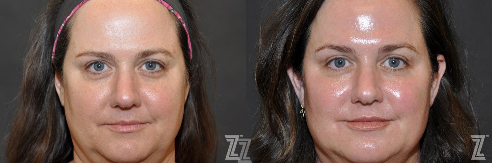 Injectable Fillers Before & After Gallery - Patient 132906324 - Image 1
