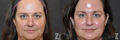 Austin Injectable Fillers Before & After Gallery - Patient 132906324 - Image 1 - The Piazza Center