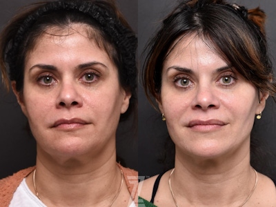 Facial Rejuvenation Before & After Gallery - Patient 189397 - Image 1