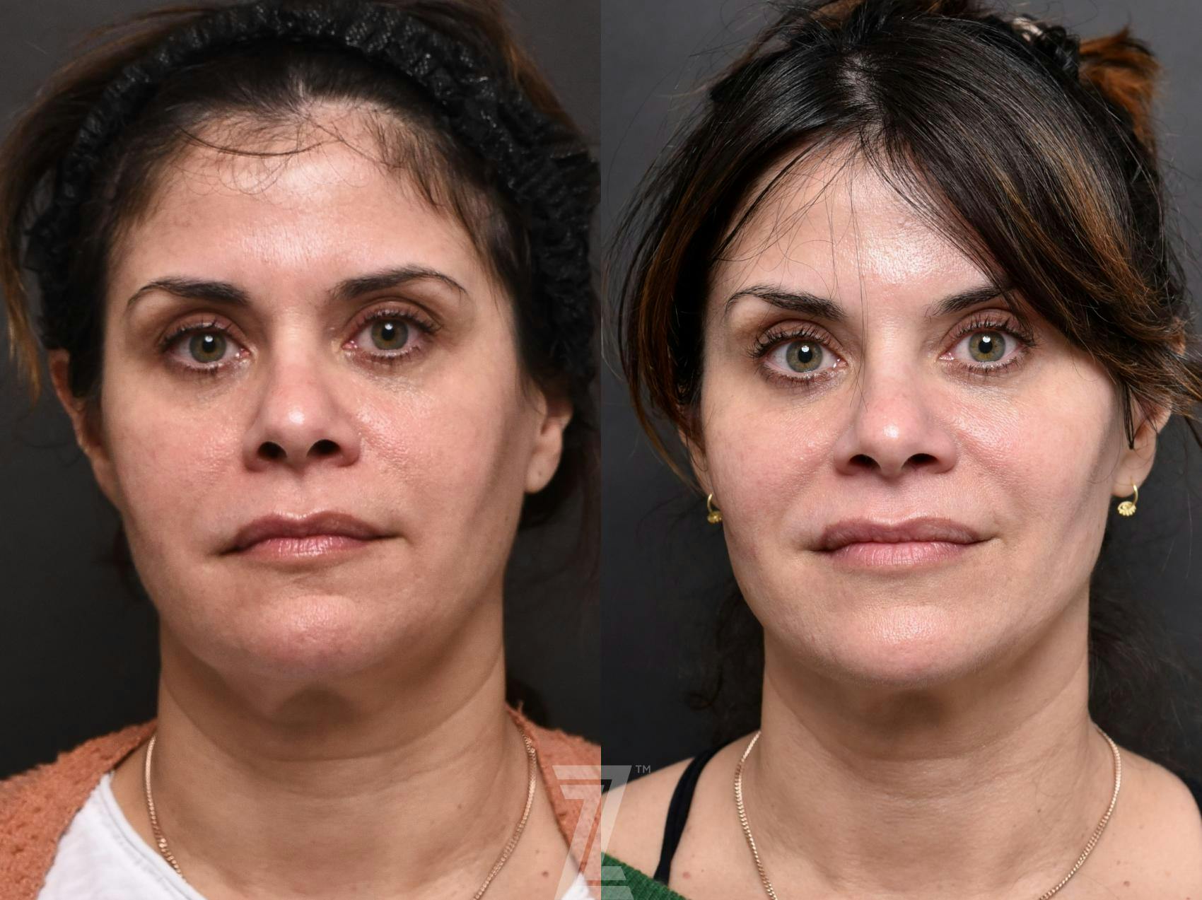 Facial Rejuvenation Before & After Gallery - Patient 189397 - Image 1