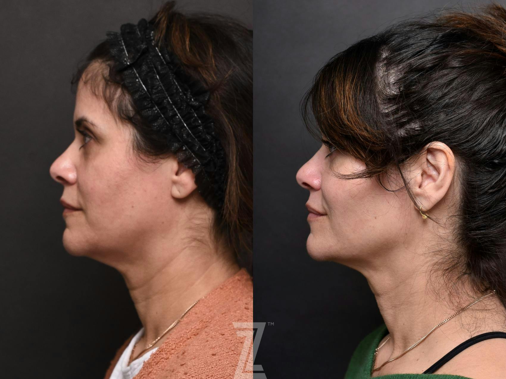Facial Rejuvenation Before & After Gallery - Patient 189397 - Image 2