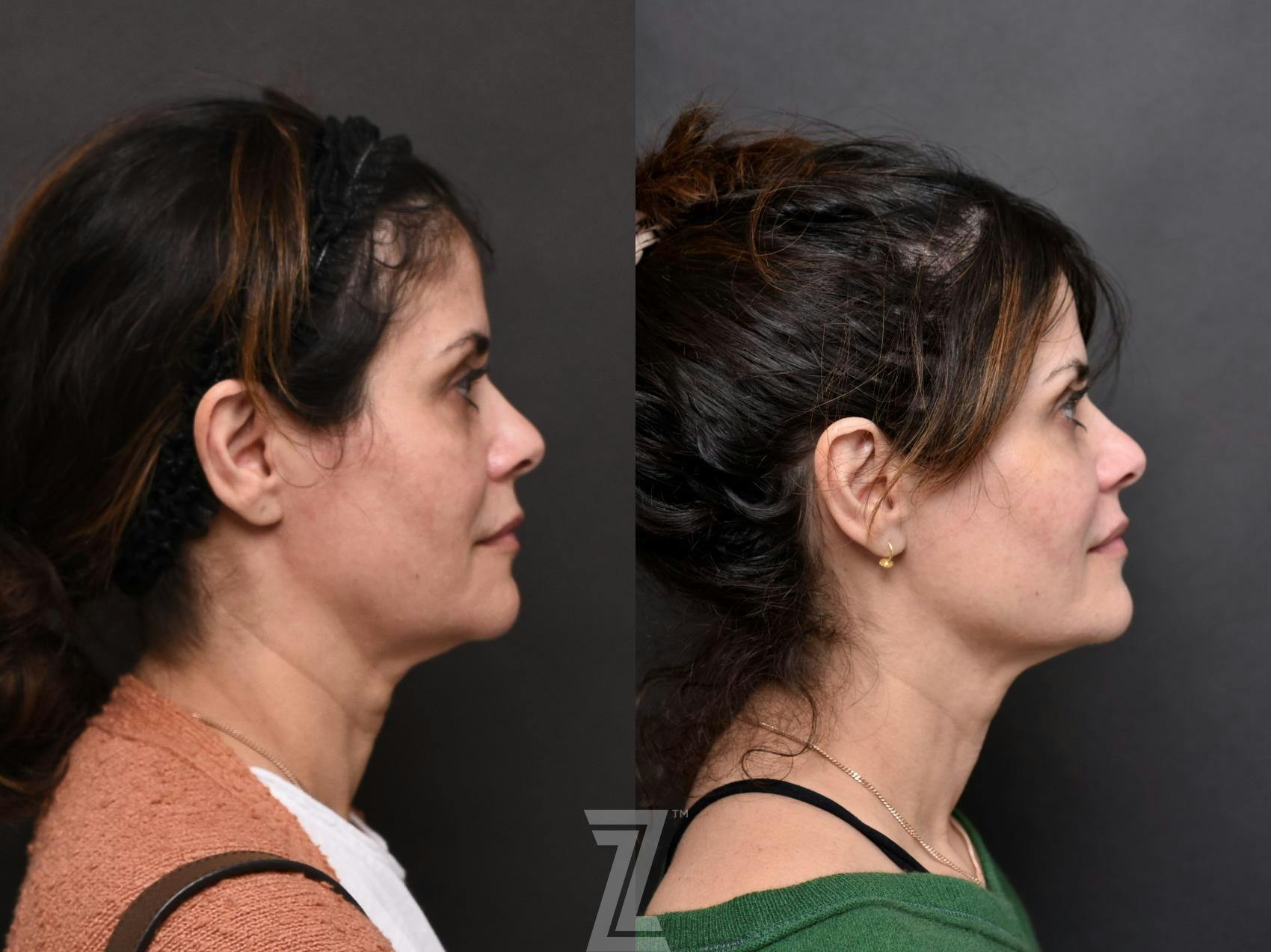 Facial Rejuvenation Before & After Gallery - Patient 189397 - Image 3