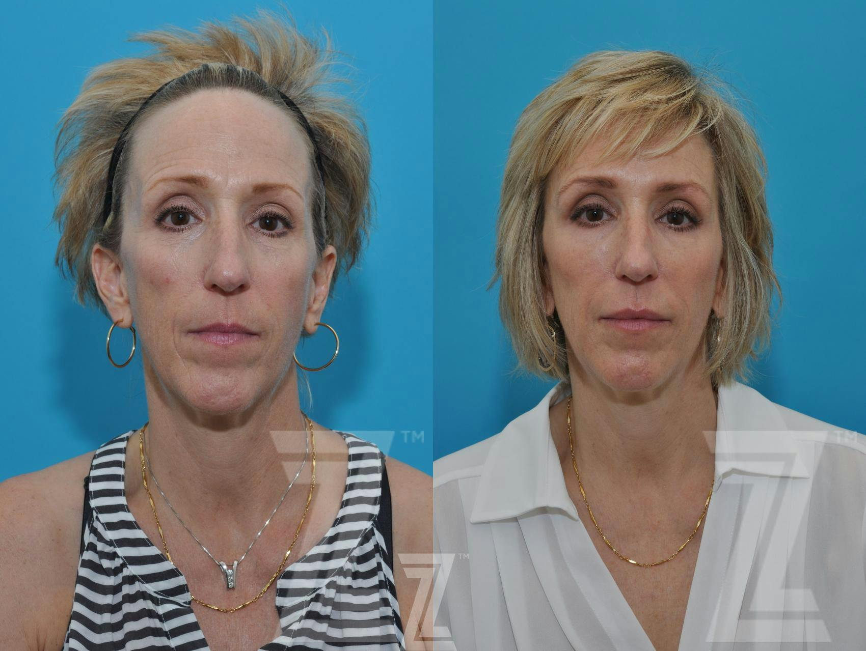 Injectable Fillers Before & After Gallery - Patient 132963096 - Image 1